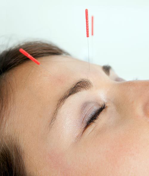 Acupuncture for your patients